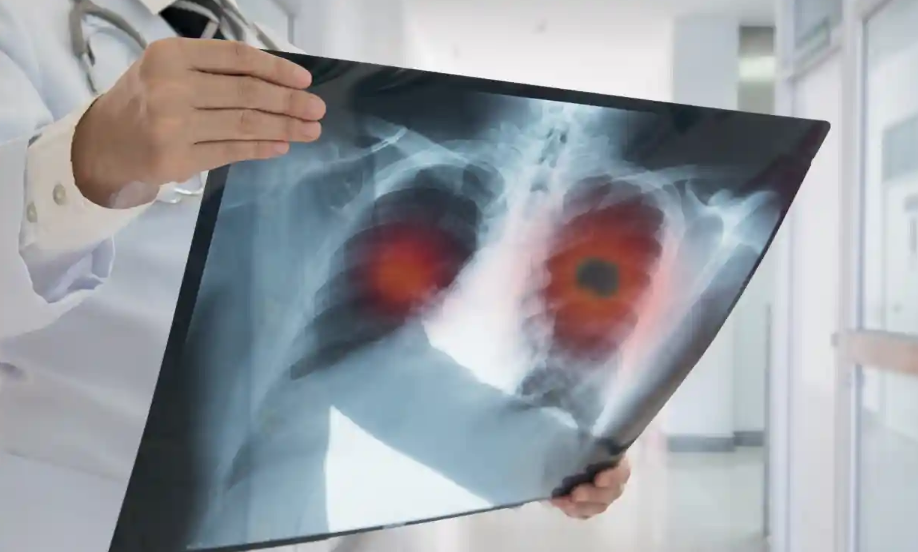 Thuốc ung thư phổi giảm một nửa nguy cơ tử vong