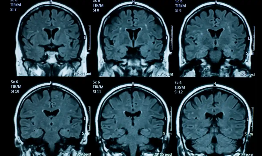 Não của thanh thiếu niên hậu đại dịch có dấu hiệu lão hóa nhanh hơn