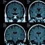 Não của thanh thiếu niên hậu đại dịch có dấu hiệu lão hóa nhanh hơn